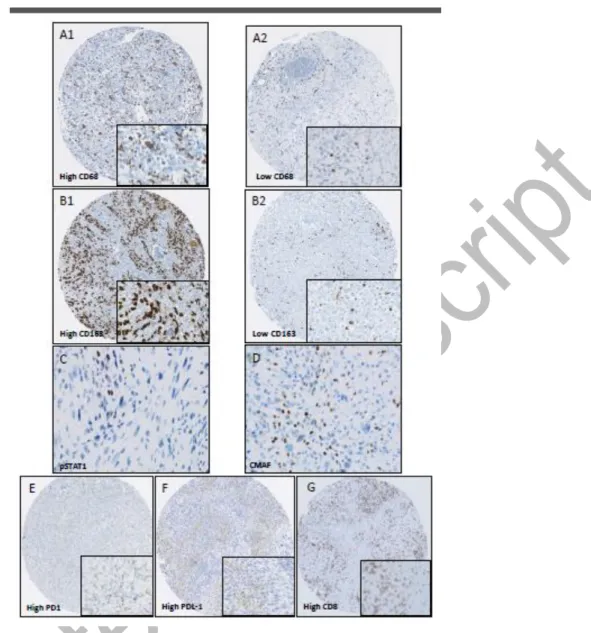 Figure 1. Immunohistochemical staining. Sample images of tissue microarrays prepared from  patient biopsies and stained for: CD68 (A1: high, A2 low); CD163 (B1: high, B2: low), pSTAT1 (C),  CMAF (D), PD1 (E: high) and PDL-1 (F: high), CD8 (G: high) (magnif
