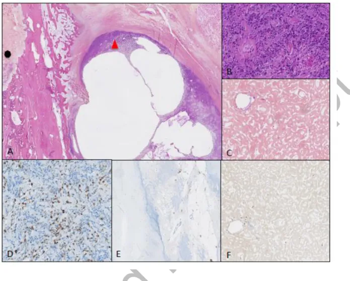 Figure 4. An example of poor responder patient treated with ZA with a viable isolated soft tissue  nodule of osteosarcoma cells, next to intramedullary necrosis areas