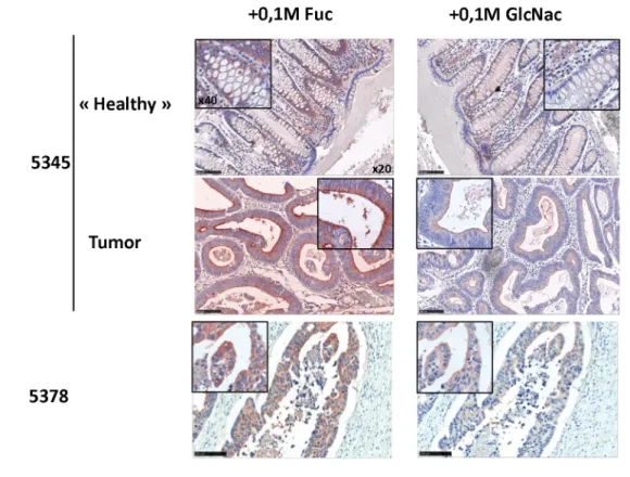 Fig 7. PVL binds to tumor tissue with a mixed Neu5Ac and GlcNAc specificity. A. Sections from ethanol-fixed colon carcinoma and adjacent healthy tissue from 2 different patients (# 5345 and 5378) were stained with 1 μ g ml -1 rPVL-biot in presence of 0.1 M