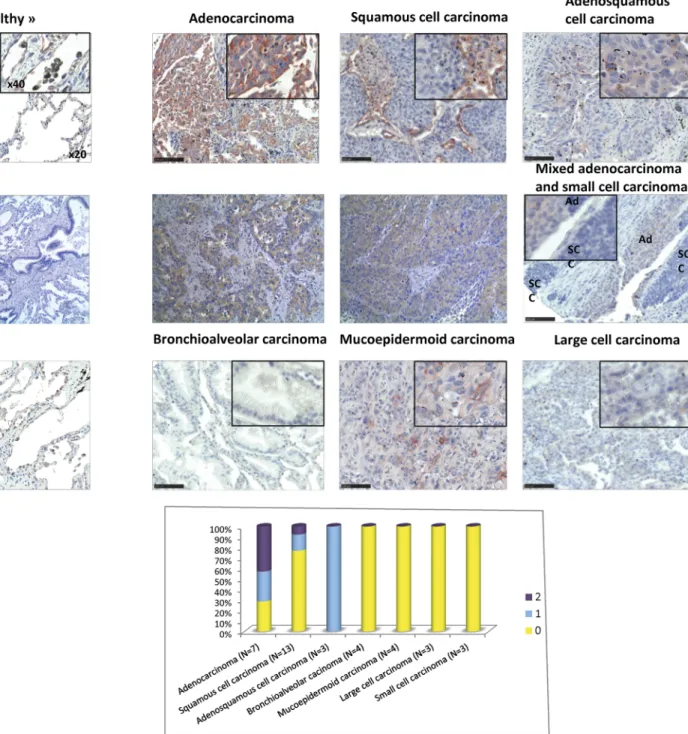 Fig 8. PVL staining of Lung tumoral tissues. A. A lung tumor TMA (formalin-fixed) was stained with 2 μ g ml -1 rPVL-biot in presence of 0.1 M fucose followed by Streptavidin-HRP