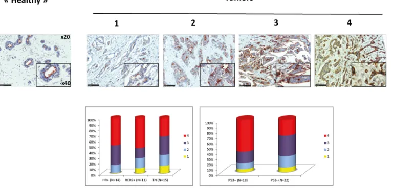 Fig 9. PVL staining of breast tumoral tissues. A. A Breast tumor TMA (formalin-fixed) was stained and imaged as described in Fig 8A