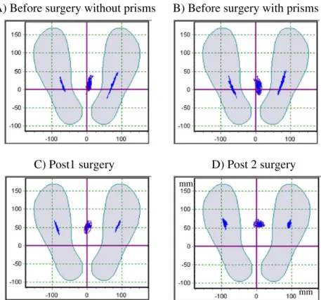 Fig. 1 The sway path of the center of pressure for each foot and in the middle the mean of the feet during postural recording from child C5 before surgery without (A) and with prisms (B), and in the post 1 (C) and post 2 (D) surgery condition recorded at n