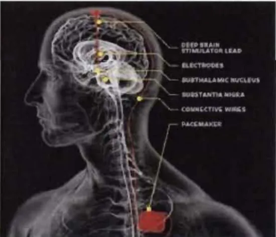 Figure 1.9  Représentation  de  la  stimulation  cérébrale  profonde.  (Tirée  de  