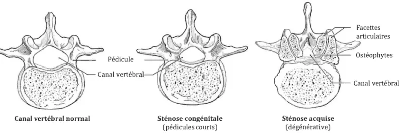 Figure  1.3 Représentation de  la sténose  lombaire congénitale et acquise  (Adaptée du  site www