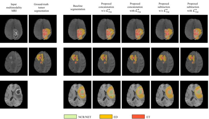 Figure 3. The segmentation maps produced by the different evaluated methods displayed on post-contrast Gadolinium T1-weighted modalities