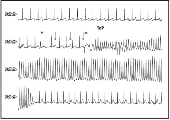 Fig. 2. Example of VT and Torsade de Pointes in a 32-year old woman treated for paroxysmal AF and after attempted suicide using sotalol