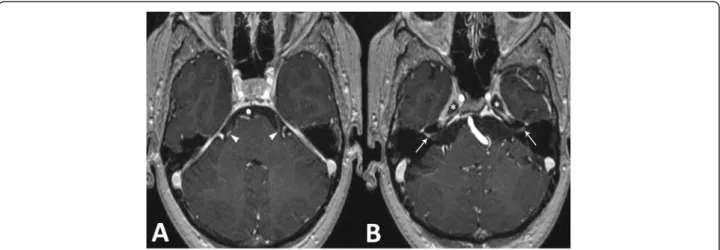 Figure 1 Axial MRI images of the brain. Post gadolinium enhanced T1 weighted sequence on initial exam shows (A) bilateral focal enhancement of the proximal portion of both trijeminal nerves (arrowheads), (B) bilateral enhancement of the vestibulocochlear a
