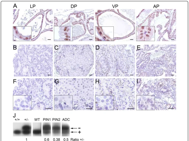 Figure 2 Menin expression is inactivated in prostate cancers from Men1 +/- mice. Microscopic images of prostate glands from Men1 +/+ (A) and Men1 +/- mice (B-I) subjected to menin detection by IHC