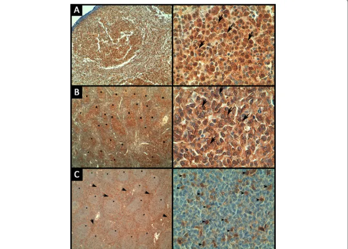 Figure 3 Representative images of immunohistochemical staining of pAKT and PTEN in FL samples