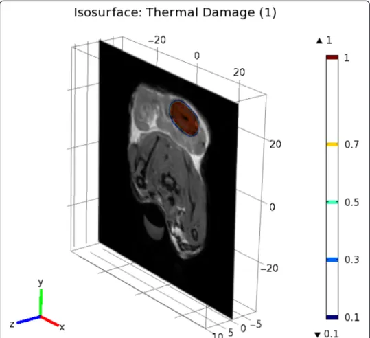 Figure 4 Iso-surface of the thermal damage matched with the 48 hours MR image. More details about the form of the thermal damage are available as a video stream