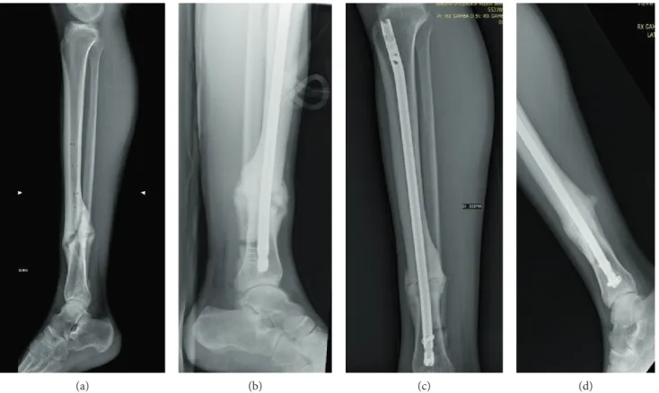 Figure 3: Representative radiological images (lateral view) of a male, 19 years, with irregular complex tibia fracture (1/3 distal diaphysis) not healed after 12 months from trauma; (a) visit 1: pretreatment, day before surgery; (b) visit 3: after implanta