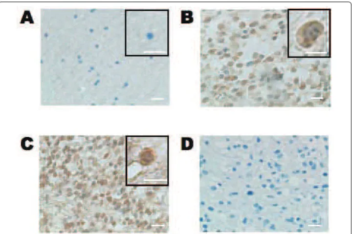 Figure 2 Immunohistochemical analysis of HOXD9 expression in gliomas and normal brain tissue