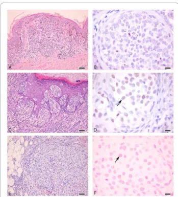 Figure 6 SKI expression in melanocytic lesions. Nevus (A, B) without nuclear staining