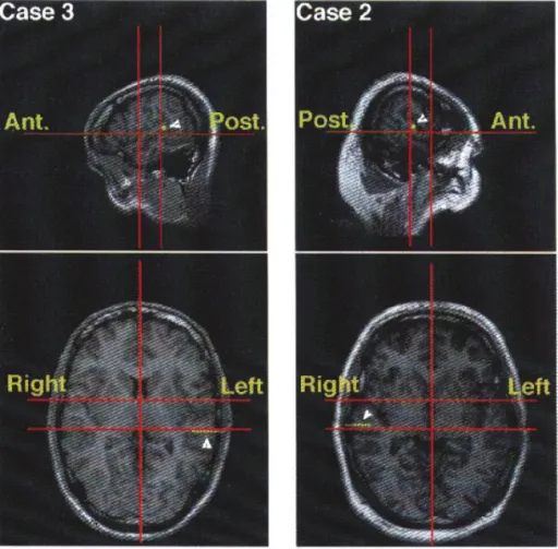Figure 2 shows a typical brain (from an MRI) in a sagittal (Fig. 2A,B) and frontal view (Fig