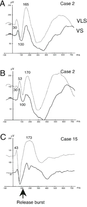 Figure 6C shows the responses recorded in the right PT. No difference is observed in waveforms of evoked responses to both stimuli.