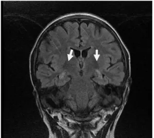 Fig.  2    A coronal FLAIR sequence with thin cuts showing  bilateral hippocampal sclerosis (white arrows)