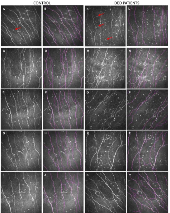 Figure 1. Representative in vivo confocal microscopy (IVCM) images (400 × 400 µm) of corneal subbasal nerves and subbasal dendritic cells from five control subjects (A,C,E,G,I) and five patients with dry eye disease (DED) (K,M,O,Q,S)