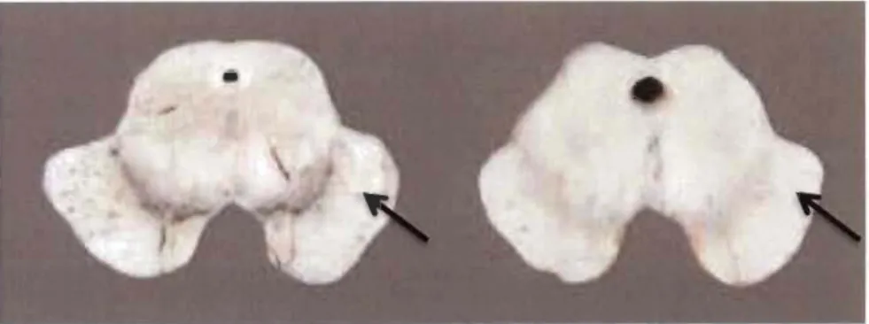 Figure 1.7  Pigmentation de la NM entre la SNpc d' un cerveau sain (gauche) et  la SNpc d'un cerveau parkinsonien (droite) [38]