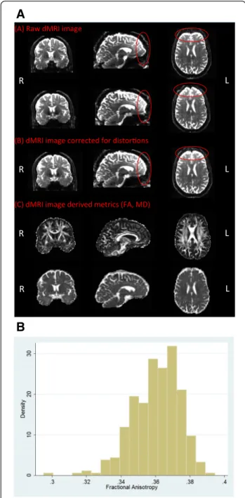 Figure 3 Diffusion MRI - analysis pipeline and initial results for fractional anisotropy