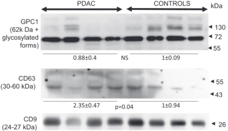 Figure 2. GPC1 is present in patient and control EV-enriched sera.Proteins extracted from patient and control sera were analyzed by western blotting for the presence of CD63 and CD9 exosome markers and for GPC1 proteins