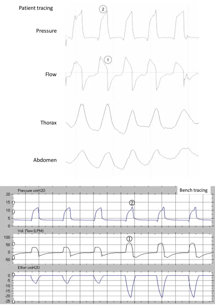 Figure S9a: Underassistance during the whole cycle   Pressure Flow Thorax AbdomenPatient tracing Bench tracing