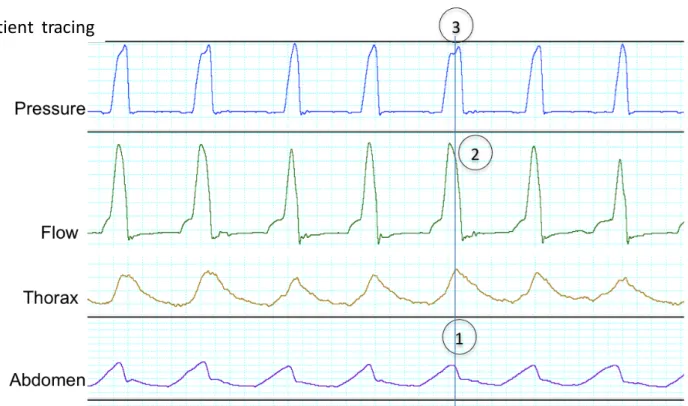Figure S11a : Delayed cycling with expiratory effort 