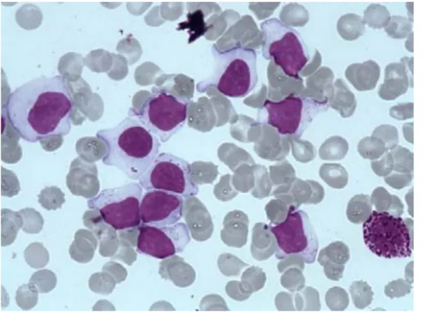 Fig 1A: A typical large granular lymphocyte on blood smear. (Wright-Giemsa stain: 