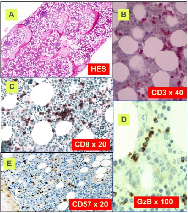 Figure 4: Bone marrow features of LGL leukemia   