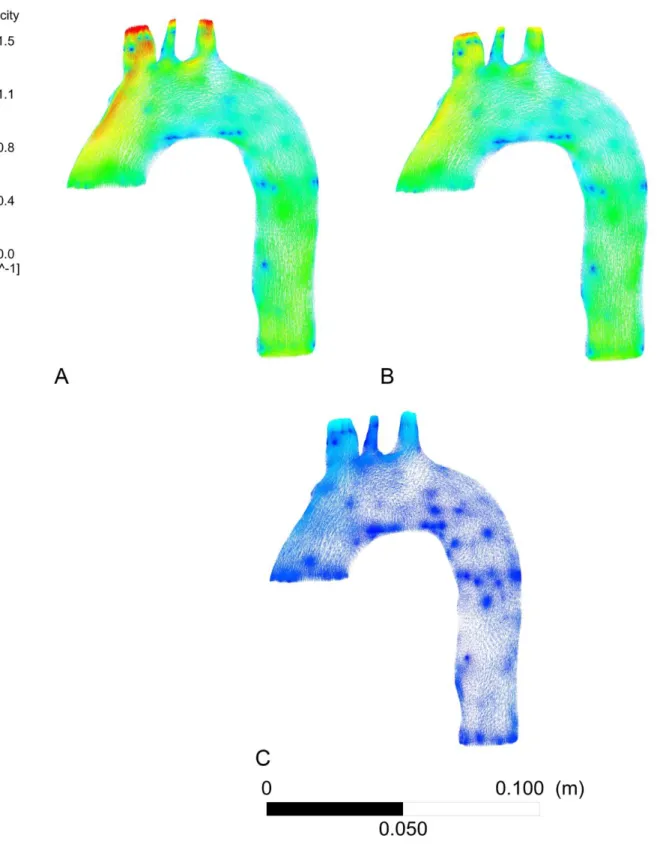 Figure 12: Comparison of 3D model of aortic blood velocities fields of the healthy patient  A: 3D modeling of velocities fields in the aorta of the healthy patient from 2D CP MRI data, 