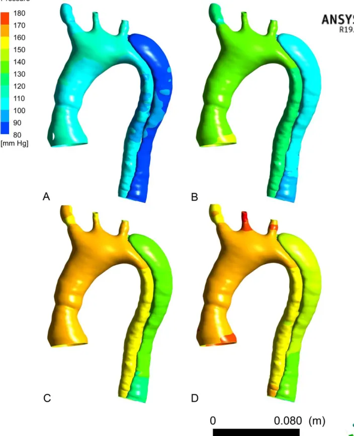 Figure 13: 3D modelling of aortic pressure wall of the dissected patient   A: from 0D model simulation, &#34;controlled pressure&#34; scenario 