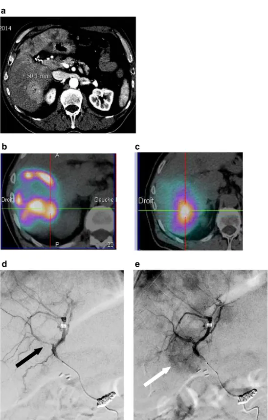 Fig. 2 MAA and glass miscrosphere uptake discrepancy related to transient arterial vasospasm