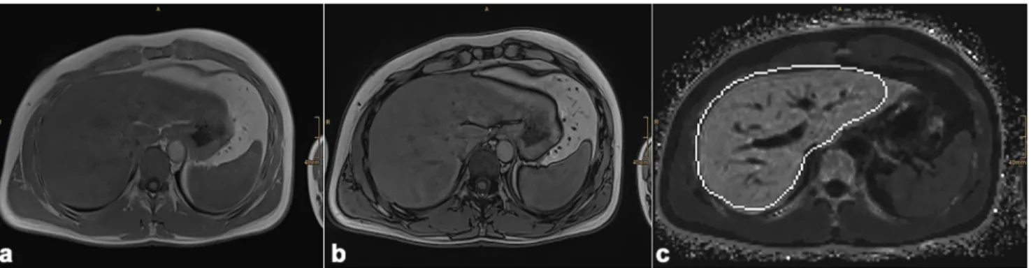 Fig. 1 Example of a chemical shift sequence which already indicates a pathological iron deposition