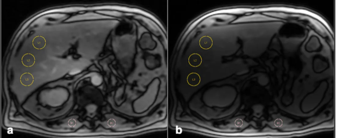 Fig. 2 Three examples (a–c) of a liver ME-GRE sequence obtained at 1.5 T with 12 echoes showing for each patient a selection of TE = 4.8 and 14.8 ms images (first line) and also a MRQuantif graph (second line) plotting the signal intensity according to TEs