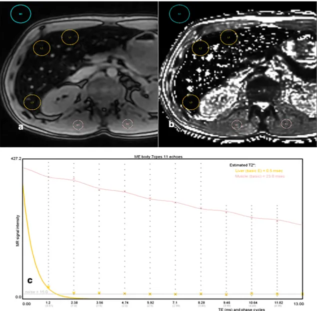 Fig. 5 High LIC with 3-T imaging. a 2D ME-GRE sequence (first TE = 1.2 ms) obtained with body coil showing signal collapsed with a LIC of 521 μ mol Fe/g as estimated by SIR method