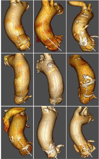 Fig. 3: Examples of centerlines extraction and aorta segmentation for 9 patients 