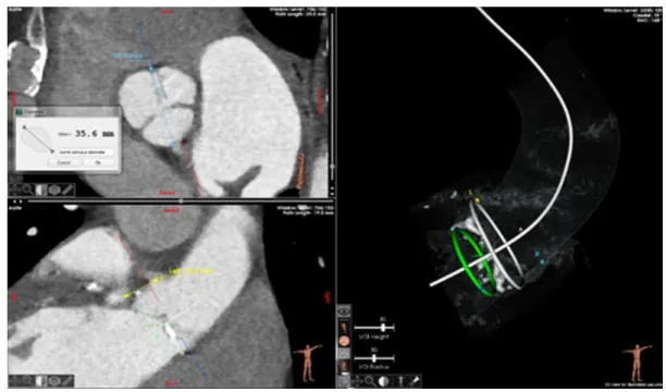 Fig. 5: Visualization of the measurement step within the EndoSize® TAVI module 