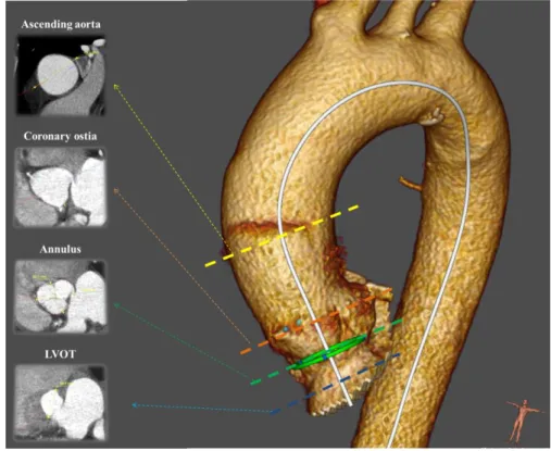 Fig. 2: Visualization of the different aorta levels 