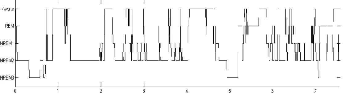 Figure 1: Hypnogram of a patient with a suspicion of OSAS. 