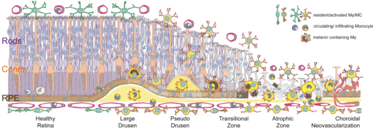 Figure 2: Mononuclear phagocyte accumulation in AMD 