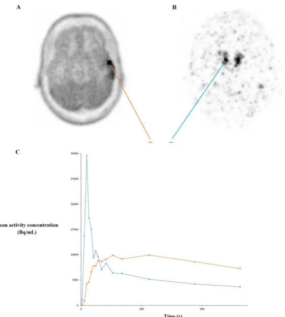 Fig 2. Axial FDOPA PET images show glioma uptake in a 50-year-old man (A) and the injected FDOPA bolus (176 MBq) on the right middle cerebral artery (B) with arterial and glioma time-activity curves (C).
