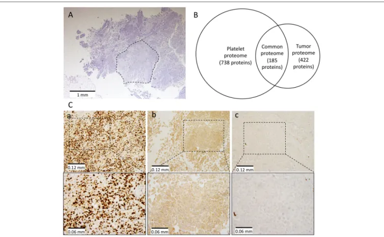 FIGURE 2 | Proteomic and immunohistochemistry analyses on patient’s platelets and tumor