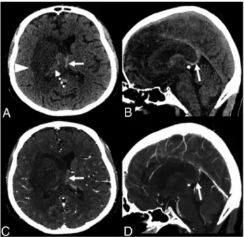 FIG 2. Axial FLAIR ( A ), SWI ( B , D , and E ), and postcontrast T1-weighted MR images ( C and F ).
