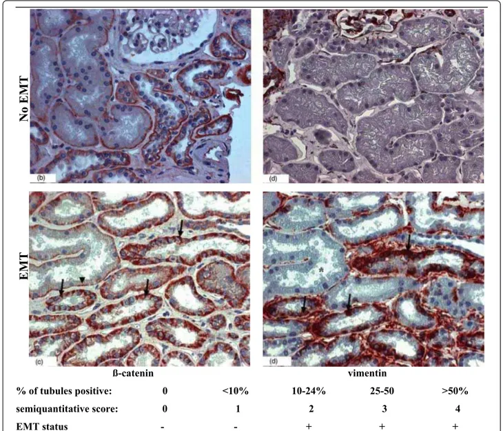 Figure 1 Detection of epithelial to mesenchymal transition (EMT) by b-catenin and vimentin immunostaining, and definition of the subsequent prognostic EMT score