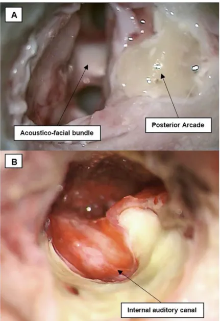 Fig 5. Acoustic-facial bundle in CPA and IAC exposure. (A) The acoustic-facial bundle (CN VII/VIII) could be seen emerging from the medulla, and entering the internal auditory canal (IAC)