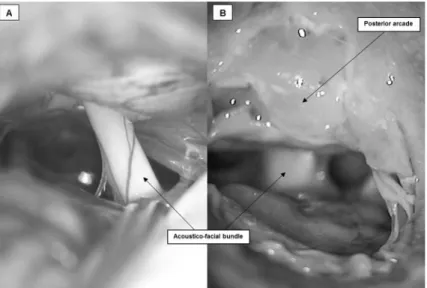 Fig 6. Comparison between CPA microscopic view and acoustic-facial bundle in (A) human (courtesy of Dr Y.