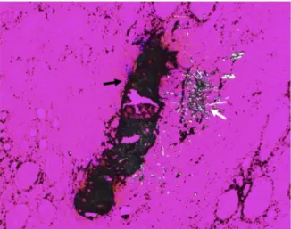 Fig. 4. Crystal deposit observed by polarizing microscopy within the papilla of a kidney