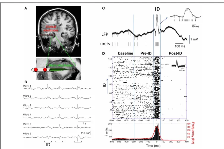 FIGURE 1 | (A) Macro- and micro-electrodes superimposed on a magnetic resonance imaging scan