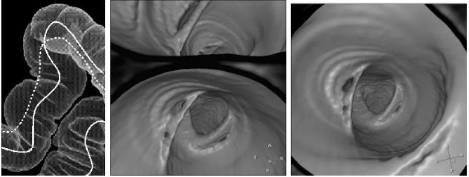 Figure 3.7. Comparing normal and centered paths: The left image is a Tissue Transition Projection (TTP) of the colon surface; middle image is the endoscopic view obtained with the classical trajectory (represented with a doted curve) in the U-turn shown in
