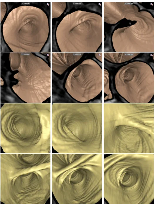 Figure 3.9. Virtual Endoscopy in the colon, minimal and centered paths: