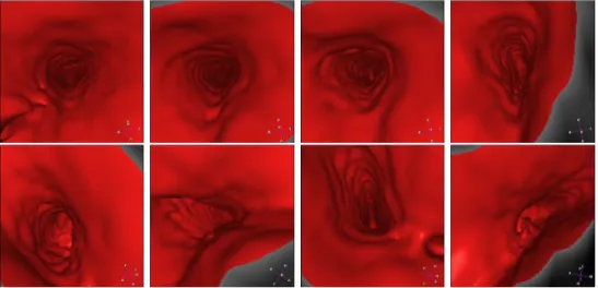 Figure 3.19. Virtual Endoscopy in a brain vessel: the virtual camera goes into the superior sagittal sinus venous canal.